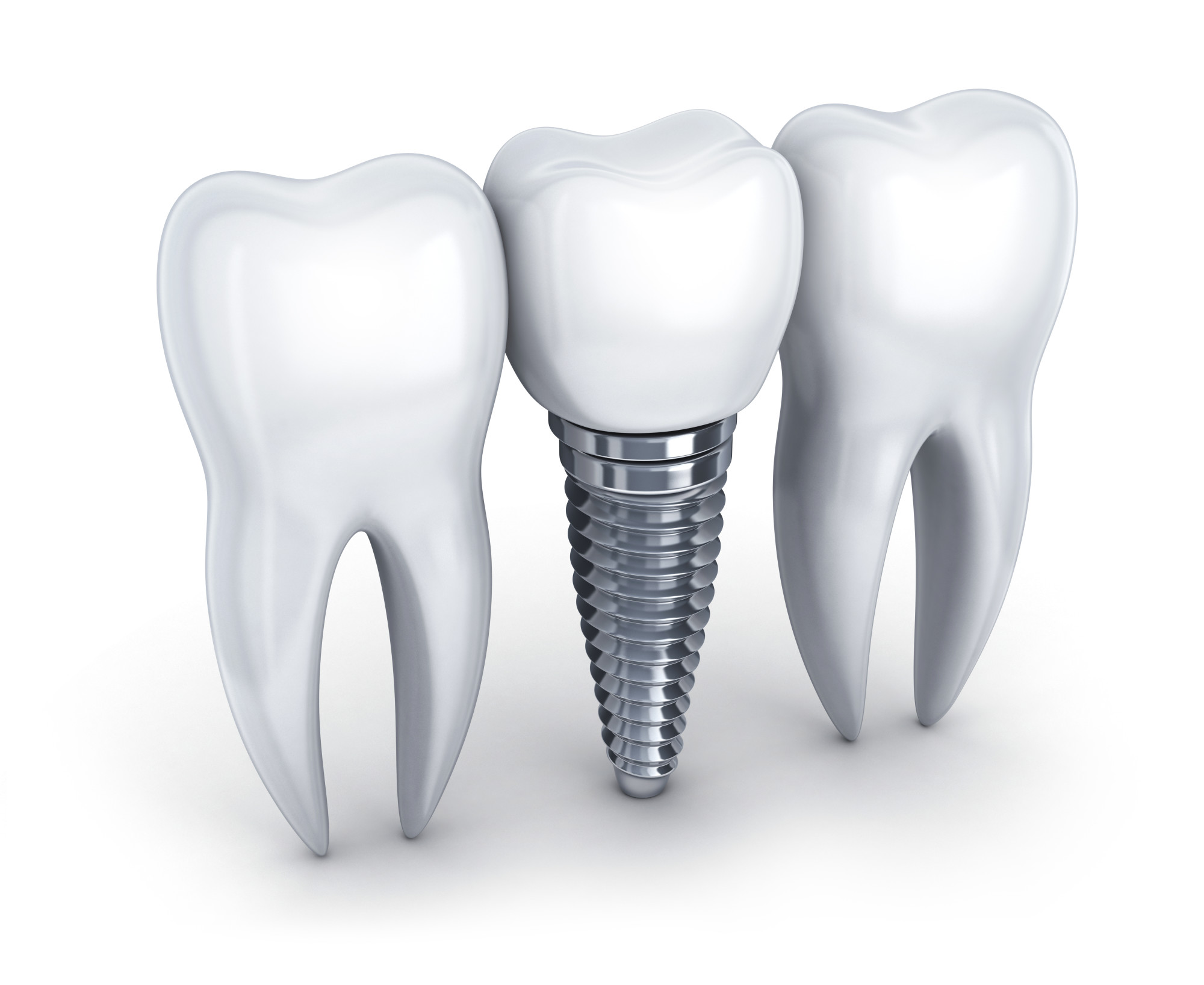 cost of dental implants
