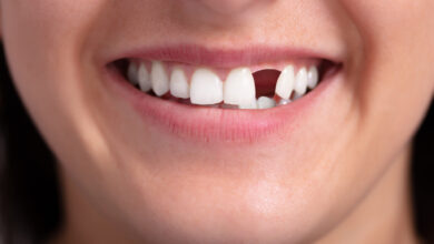 Photo of 4 Options to Replace Missing Teeth
