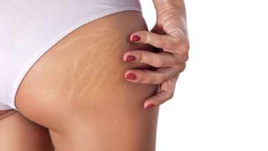 Photo of Stretch Marks Removal: 3 Things You Should Know