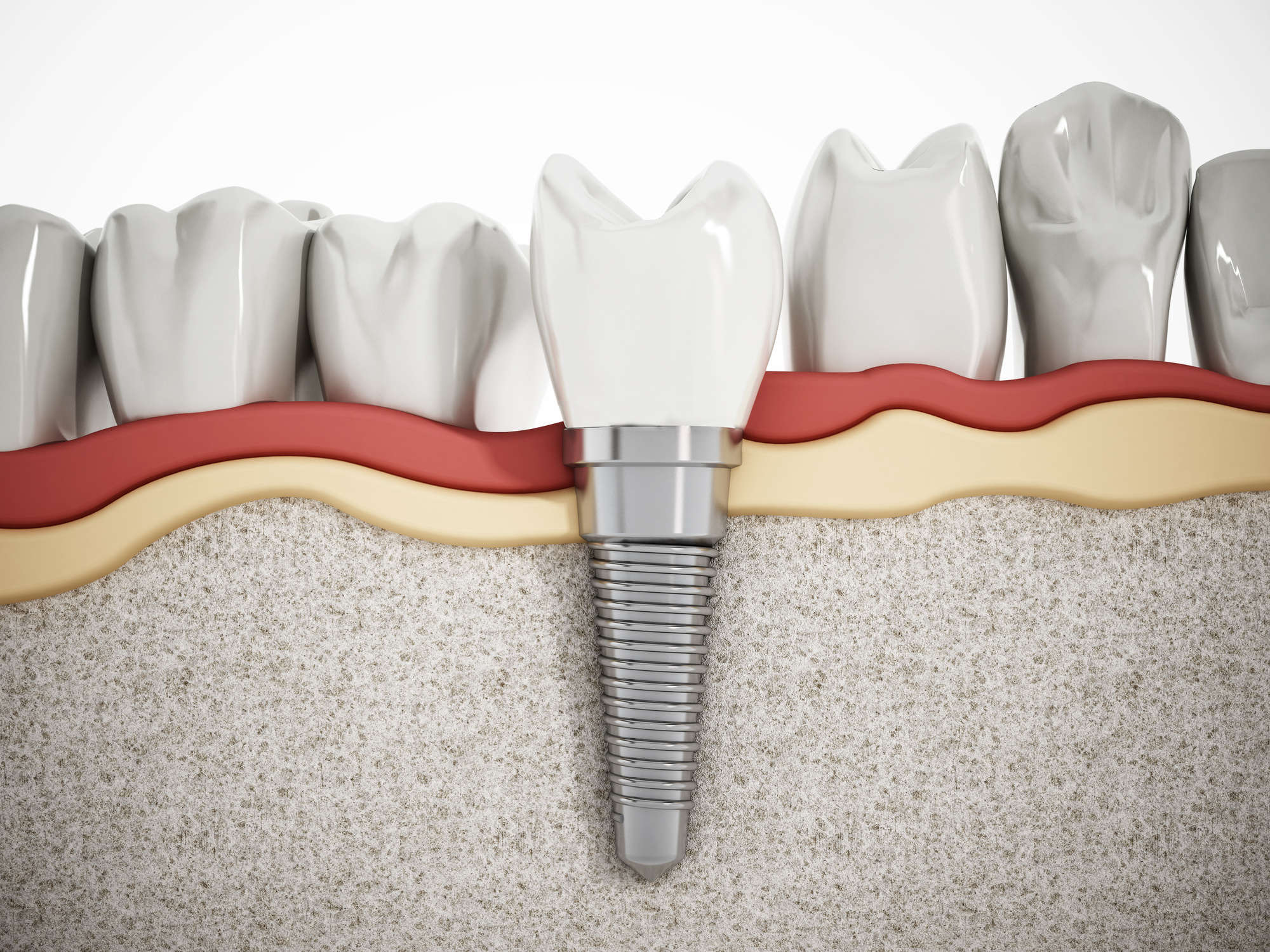 when is it too late to get dental implants
