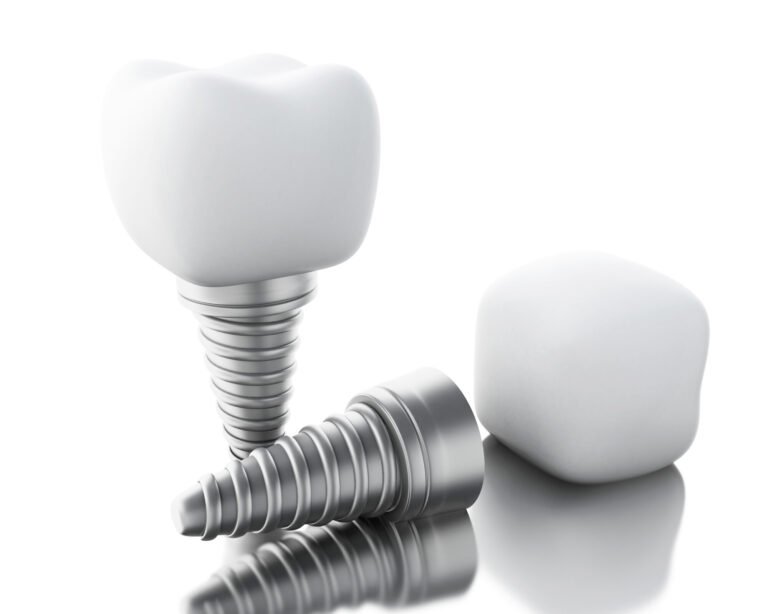 dental implants cost