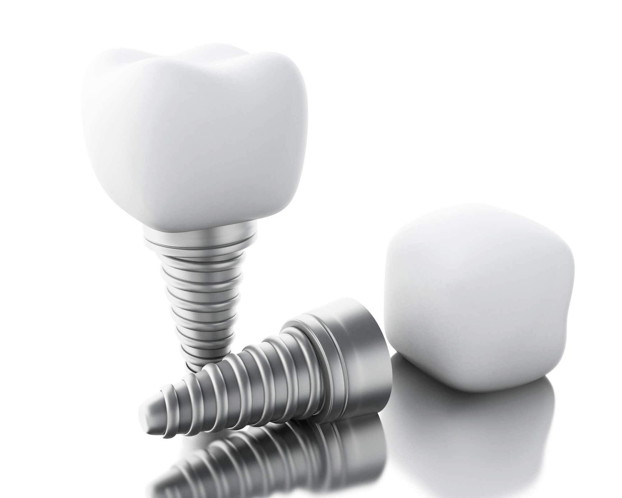 Dental Implants Cost: 3 Things You Should Know