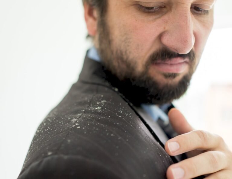 Dandruff and an Itchy Scalp