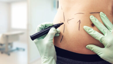 Photo of 4 Common Questions About Tummy Tuck ScarsAnswered