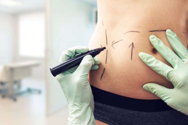 tummy tuck scar