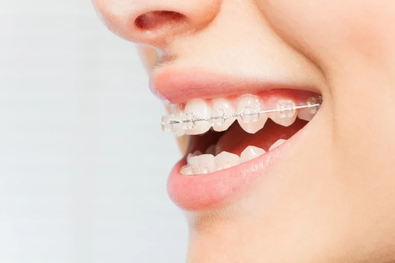 crooked bottom teeth