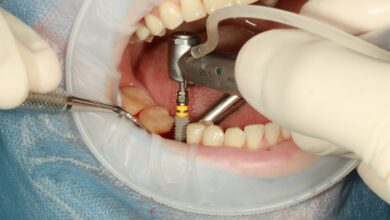 Photo of A Patient’s Guide to Dental Implant Abutment