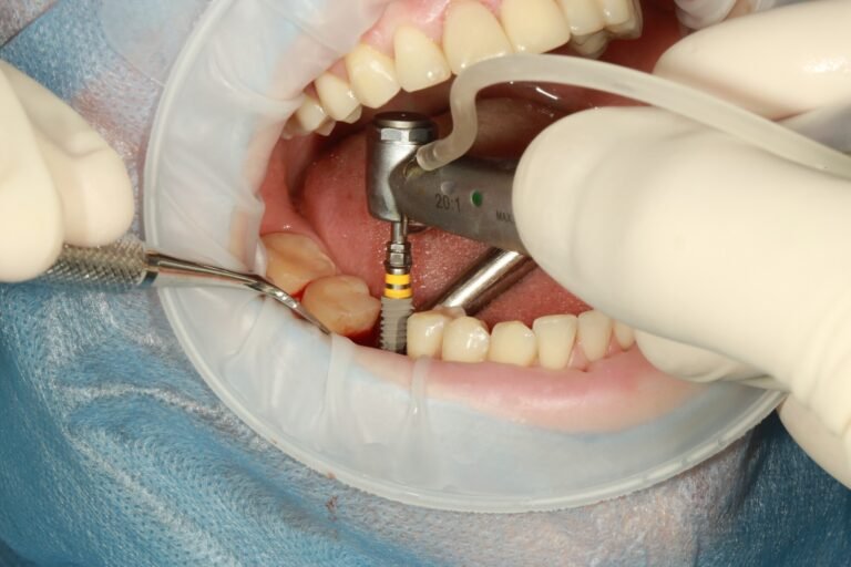 implant abutment
