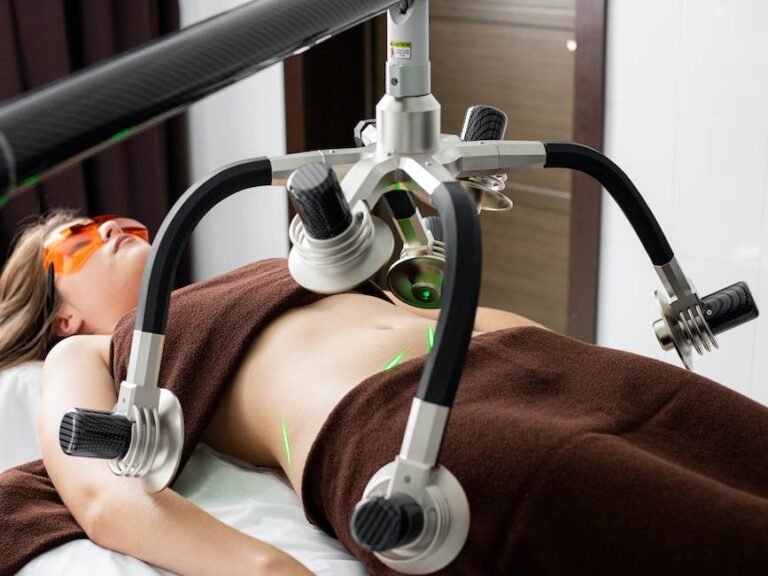 laser treatment for stretch marks