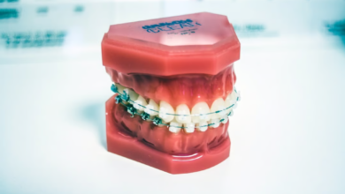 Photo of 3 Signs of a Severe Underbite in Children