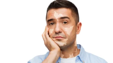 Photo of Skin Color Discoloration in Humans: What Causes It?