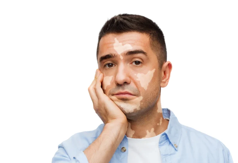 skin color discoloration