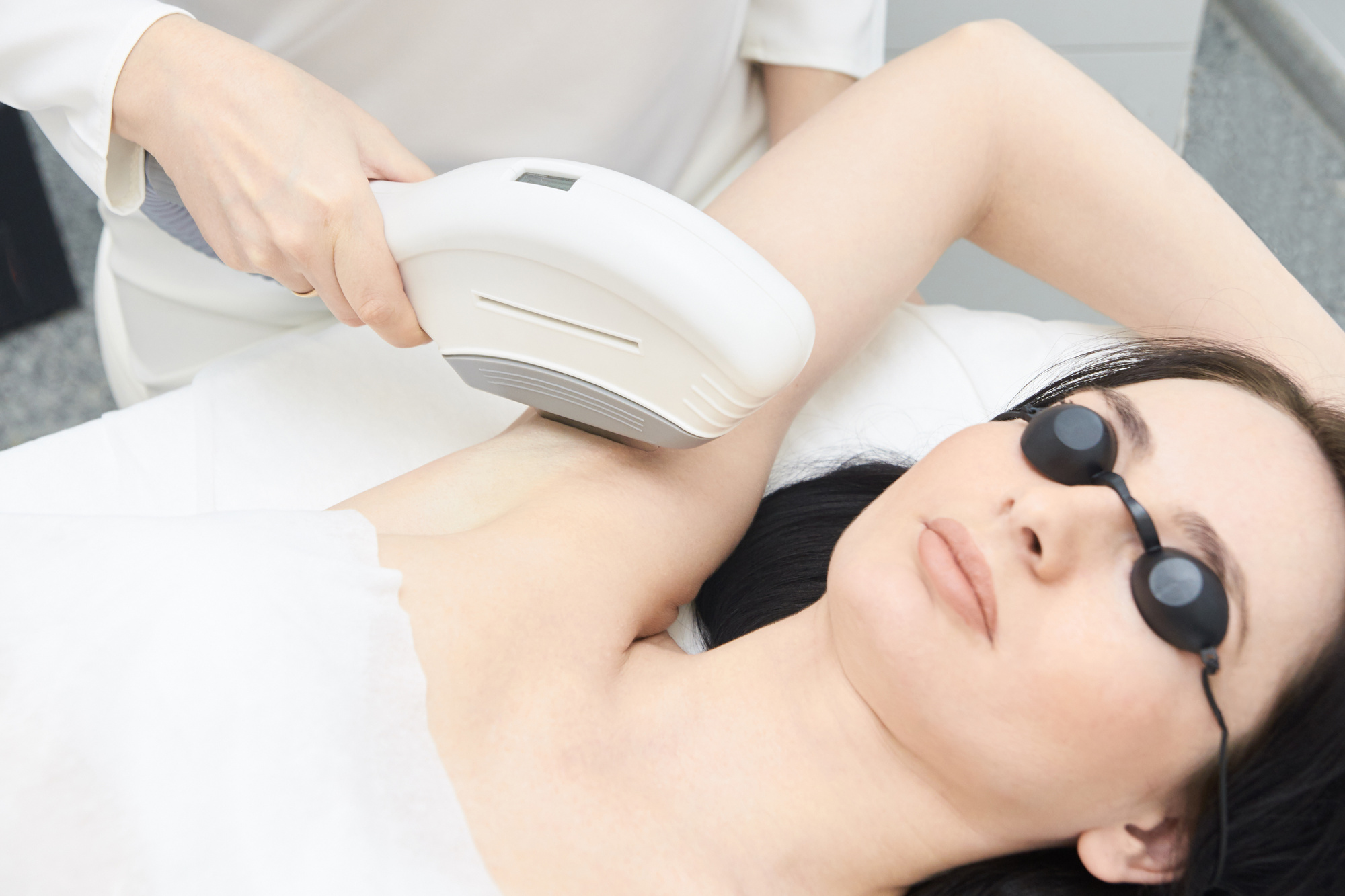 underarm laser hair removal