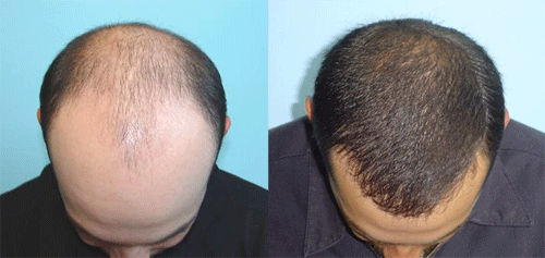Photo of A Revolutionary Hair Loss Solution Transforms Lives in Canada
