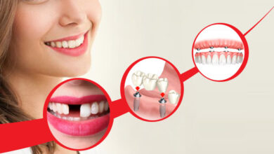Photo of The Ultimate Solution for Missing Teeth:The World of Dental Implants